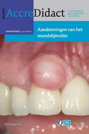 Aandoeningen van het mondslijmvlies Superprijs